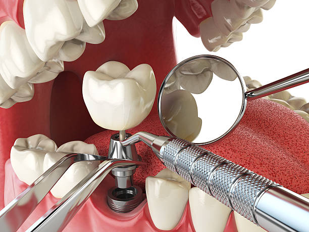Best Emergency Dentist for Lost Fillings or Crowns in Watertown, TN